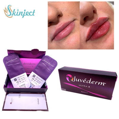 Nasolabial Folds Lips 2x1ml Chất làm đầy da Hyaluronic Acid Juvederm Ultra3