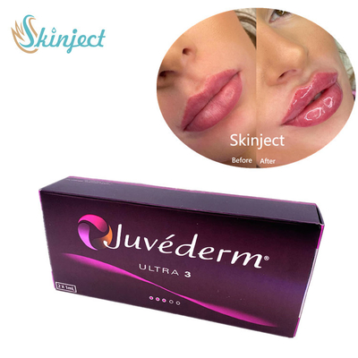 Juvederm Ultra3 Chất làm đầy da mặt Axit Hyaluronic 2x1ml Da