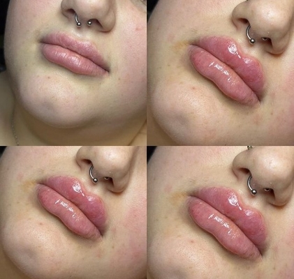 Revolax Deep HA Dermal Filler Lip Tiêm Ce Marked