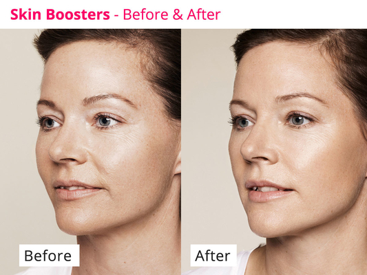 Trẻ hóa da PDRN Skinbooster Meso Serum để tái tạo collagen