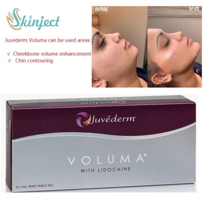 Juvederm Voluma 2x1ml Chất làm đầy da Hyaluronic Acid cho xương gò má