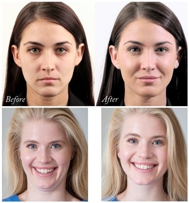 Juvederms Voluma Hyaluronic Acid Facial Filler để tăng cường sắc tố cằm và má