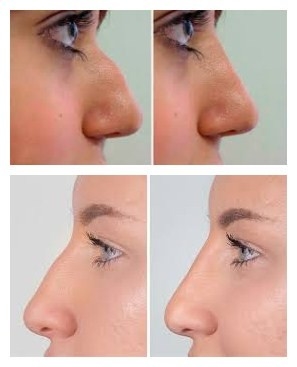 Juvederms Voluma Hyaluronic Acid Facial Filler để tăng cường sắc tố cằm và má