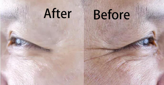 Hyaluronic Acid Filler Tái tạo Collagen Tiêm làm trắng và chống lão hóa