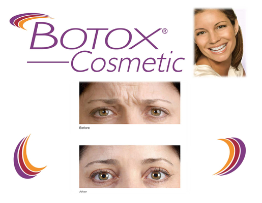 100 đơn vị Allergan  Tiêm chống nếp nhăn cho khuôn mặt