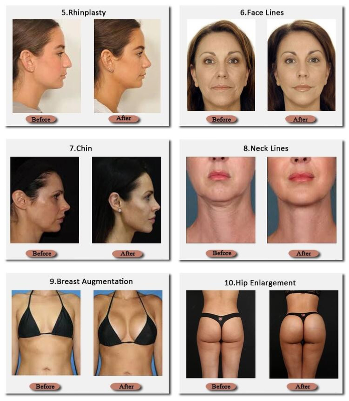 Skinjection 10 Ml Và 20 Ml Chất Làm Đầy Ngực Hyaluronic Công Nghệ Hàn Quốc 24 Mg/Ml