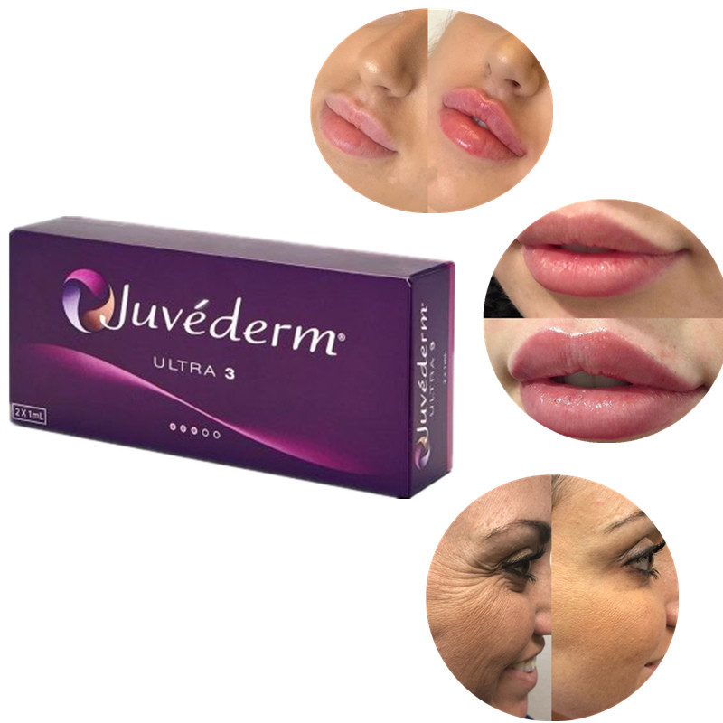 Chất làm đầy axit hyaluronic qua da liên kết ngang an toàn cho mọi loại da