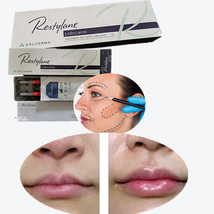 Bộ sạc da mũi tiêm môi sản phẩm gốc Hàn Quốc Authentic Sodium Hyaluronate Lip Filler
