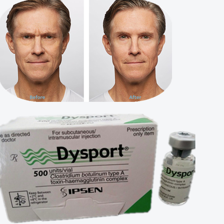 Botulinum Toxin Dysport 100IU Botulinum Toxin loại A để loại bỏ nếp nhăn