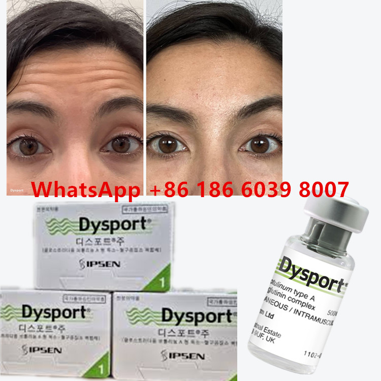 Botulinum Toxin Dysport Clostridium Botulinum Type A 500 đơn vị/ lọ