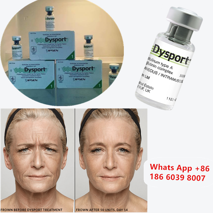 Dysport 500u Botulinum Toxin Type A để Nâng Cao Má