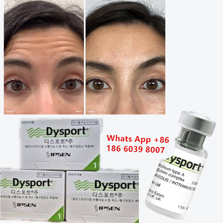 Bột đông khô Botulinum Toxin Dysport Chống nhăn để thon gọn mặt
