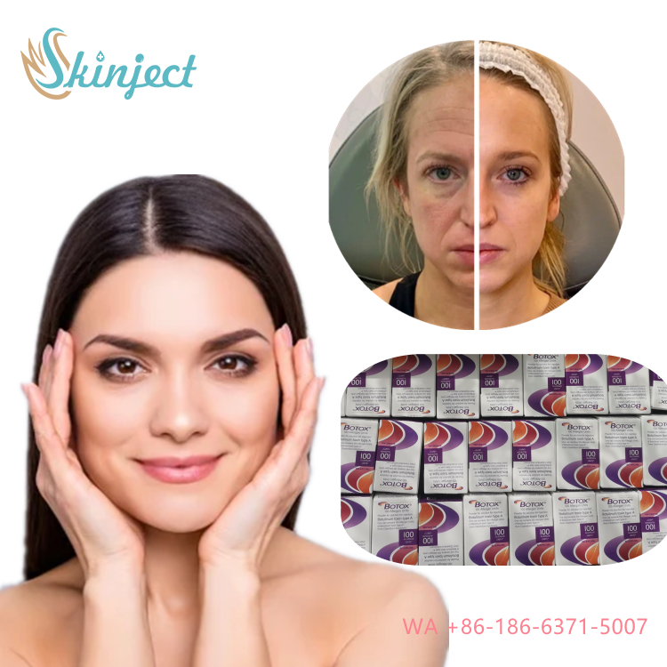 Allergan Botox Nobota 100u 200u để điều trị hiệu quả các đường nhăn mặt mũi tiêm độc tố botulinum