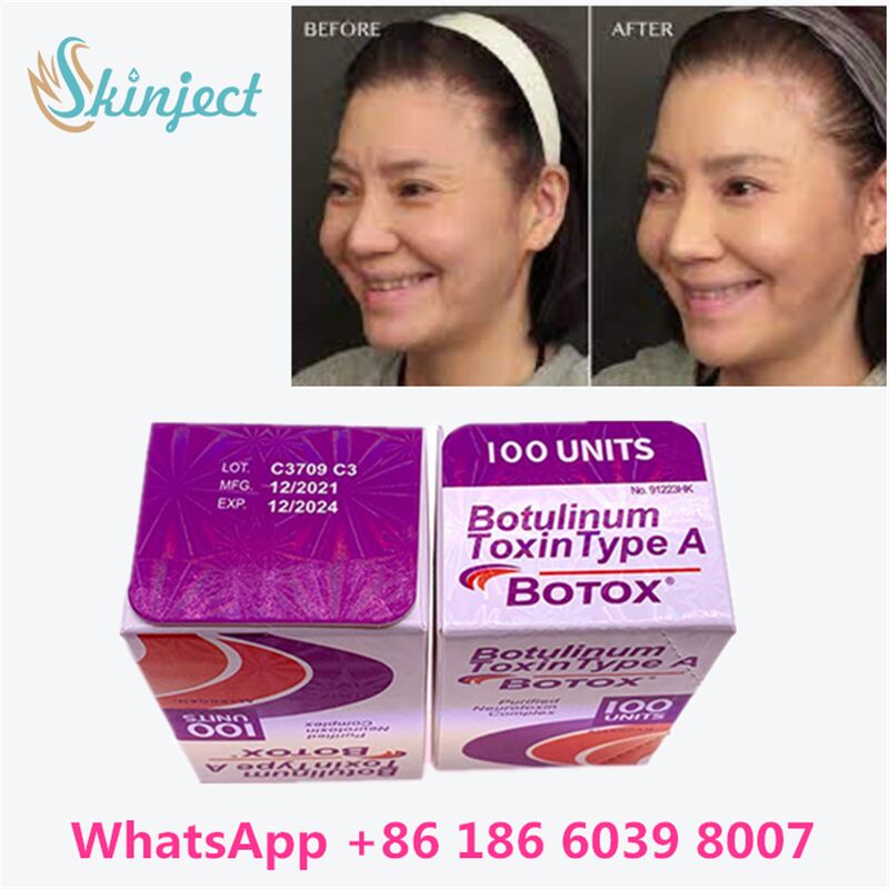 Allergan Botox Botulinum Toxin loại A 100 đơn vị để loại bỏ nếp nhăn với thời gian 4 ~ 6 tháng