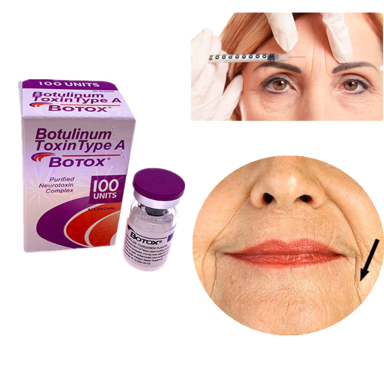 Allergan Botox 100IU Botulinum Toxin loại A Để loại bỏ nếp nhăn trên khuôn mặt và mắt
