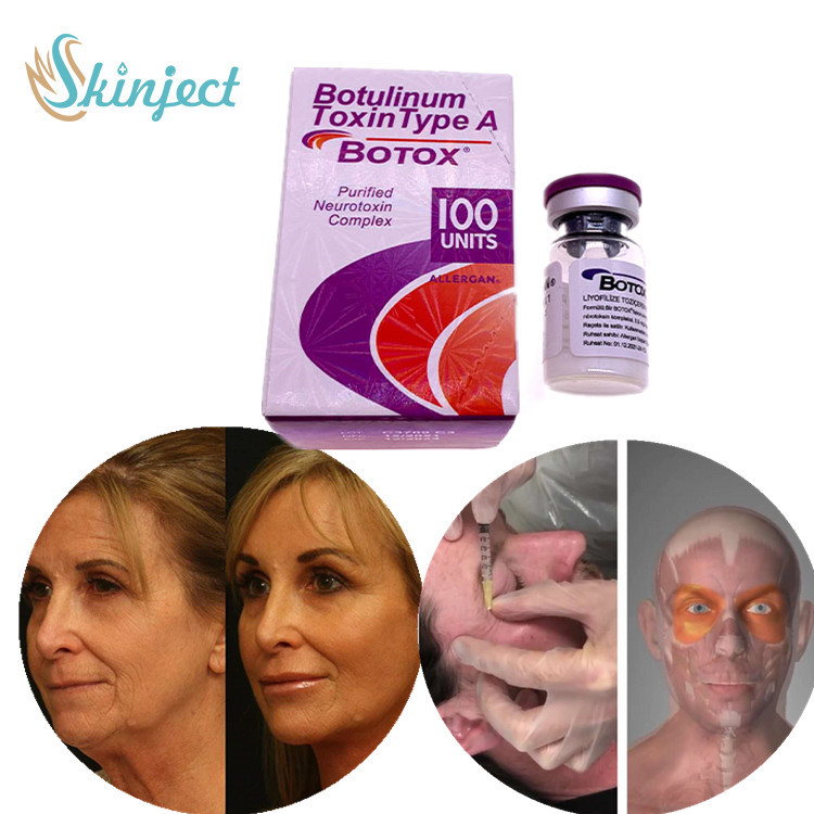 Loại bỏ nếp nhăn bằng tiêm Botulinum Toxin loại A trên khuôn mặt