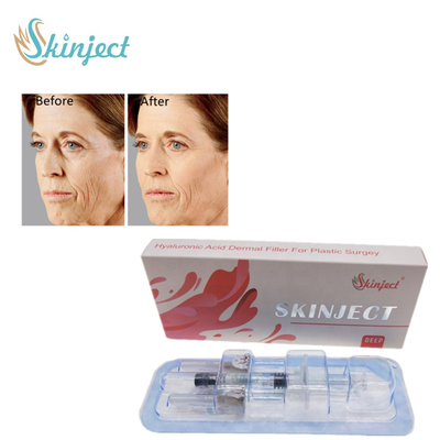 Tiêm chất làm đầy môi ngoài da cho nếp nhăn sâu và nếp gấp trên khuôn mặt