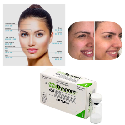 Dysport 500U Botulinum Toxin loại A để điều trị nếp nhăn