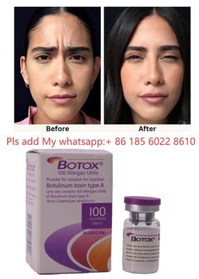 Tiêm Botox ALLERGAN, Độc tố Botulinum Loại A